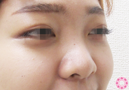 年代：20代 施術名：プチ隆鼻術（ヒアルロン酸） 施術前 拡大画像｜【公式】東京形成美容外科