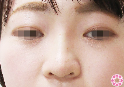 年代：20代 施術名：プチ隆鼻術（ヒアルロン酸） 施術後｜【公式】東京形成美容外科
