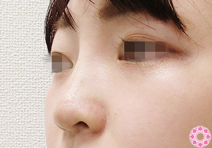 年代：20代 施術名：プチ隆鼻術（ヒアルロン酸） 施術後｜【公式】東京形成美容外科