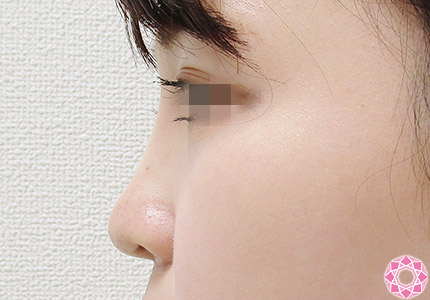 年代：20代 施術名：プチ隆鼻術（ヒアルロン酸） 施術後｜【公式】東京形成美容外科
