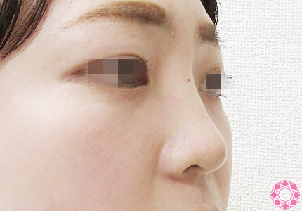年代：20代 施術名：プチ隆鼻術（ヒアルロン酸） 施術後｜【公式】東京形成美容外科