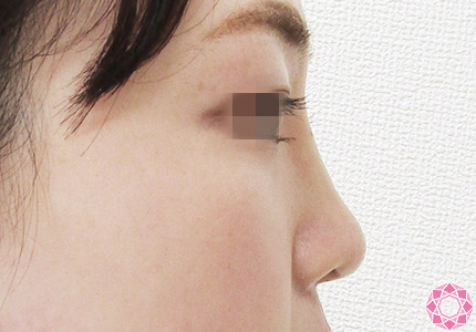 年代：20代 施術名：プチ隆鼻術（ヒアルロン酸） 施術後｜【公式】東京形成美容外科