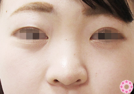 年代：20代 施術名：プチ隆鼻術（ヒアルロン酸） 施術前｜【公式】東京形成美容外科