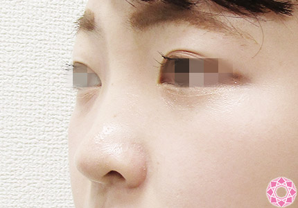 年代：20代 施術名：プチ隆鼻術（ヒアルロン酸） 施術前｜【公式】東京形成美容外科