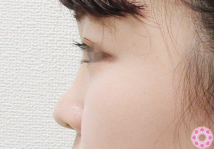 年代：20代 施術名：プチ隆鼻術（ヒアルロン酸） 施術前｜【公式】東京形成美容外科