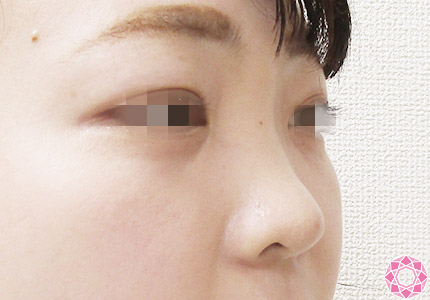 年代：20代 施術名：プチ隆鼻術（ヒアルロン酸） 施術前｜【公式】東京形成美容外科