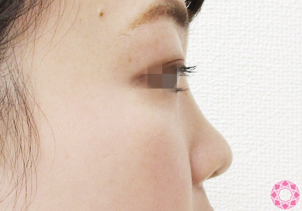 年代：20代 施術名：プチ隆鼻術（ヒアルロン酸） 施術前｜【公式】東京形成美容外科