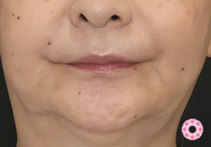 年代：60代 施術名：シワ取り（ヒアルロン酸） 施術後｜【公式】東京形成美容外科