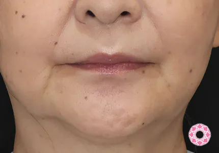 年代：60代 施術名：シワ取り（ヒアルロン酸） 施術前｜【公式】東京形成美容外科