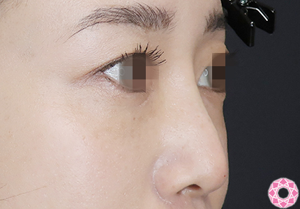 年代：30代 施術名：プチ隆鼻術（ヒアルロン酸） 施術後 拡大画像｜【公式】東京形成美容外科