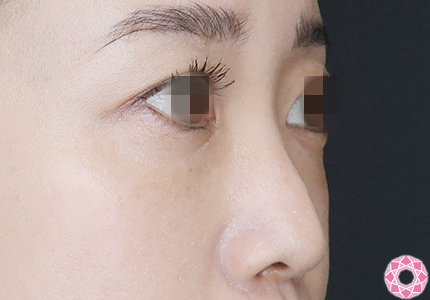 年代：30代 施術名：プチ隆鼻術（ヒアルロン酸） 施術前 拡大画像｜【公式】東京形成美容外科