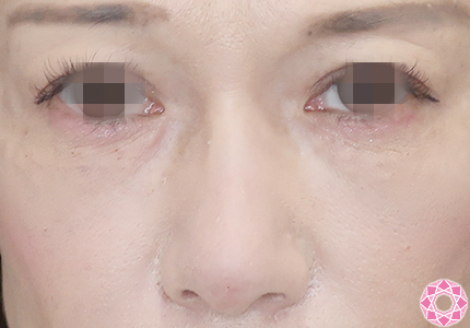 年代：40代 施術名：プチ隆鼻術（ヒアルロン酸） 施術後｜【公式】東京形成美容外科