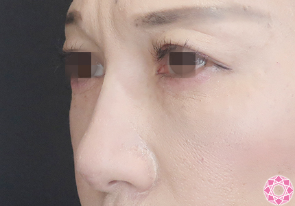 年代：40代 施術名：プチ隆鼻術（ヒアルロン酸） 施術後｜【公式】東京形成美容外科