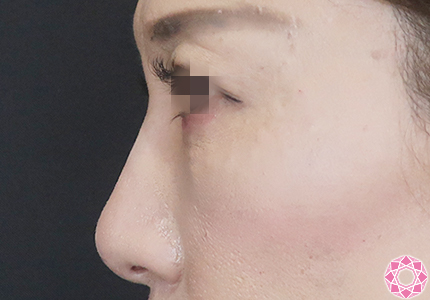 年代：40代 施術名：プチ隆鼻術（ヒアルロン酸） 施術後｜【公式】東京形成美容外科