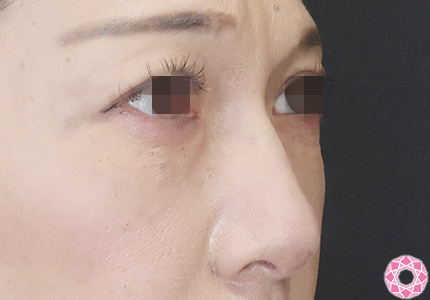 年代：40代 施術名：プチ隆鼻術（ヒアルロン酸） 施術後｜【公式】東京形成美容外科