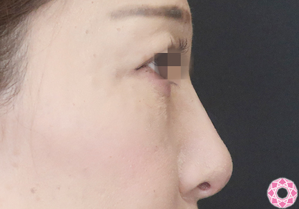 年代：40代 施術名：プチ隆鼻術（ヒアルロン酸） 施術後｜【公式】東京形成美容外科