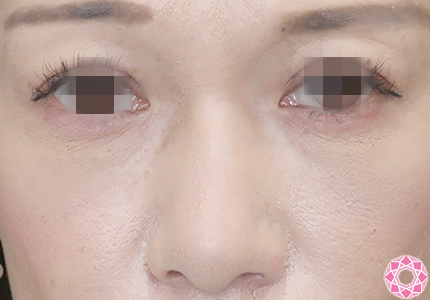 年代：40代 施術名：プチ隆鼻術（ヒアルロン酸） 施術前｜【公式】東京形成美容外科