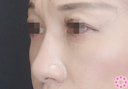 年代：40代 施術名：プチ隆鼻術（ヒアルロン酸） 施術前｜【公式】東京形成美容外科