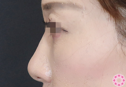 年代：40代 施術名：プチ隆鼻術（ヒアルロン酸） 施術前｜【公式】東京形成美容外科