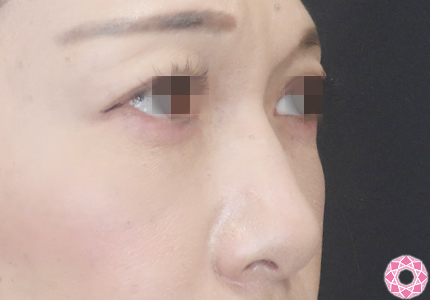 年代：40代 施術名：プチ隆鼻術（ヒアルロン酸） 施術前｜【公式】東京形成美容外科