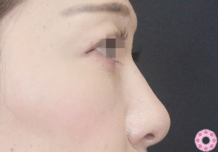 年代：40代 施術名：プチ隆鼻術（ヒアルロン酸） 施術前｜【公式】東京形成美容外科