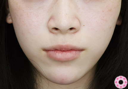 年代：20代 施術名：アゴのヒアルロン酸注入 施術後｜【公式】東京形成美容外科