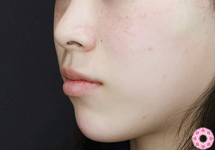 年代：20代 施術名：アゴのヒアルロン酸注入 施術後｜【公式】東京形成美容外科