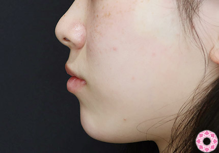 年代：20代 施術名：アゴのヒアルロン酸注入 施術後｜【公式】東京形成美容外科