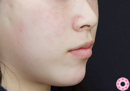 年代：20代 施術名：アゴのヒアルロン酸注入 施術後｜【公式】東京形成美容外科