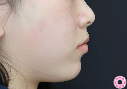年代：20代 施術名：アゴのヒアルロン酸注入 施術後｜【公式】東京形成美容外科
