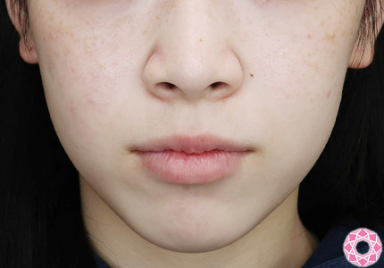 年代：20代 施術名：アゴのヒアルロン酸注入 施術前｜【公式】東京形成美容外科