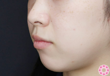 年代：20代 施術名：アゴのヒアルロン酸注入 施術前｜【公式】東京形成美容外科