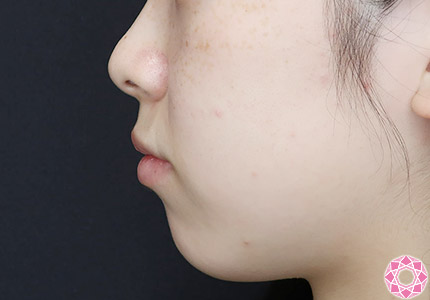 年代：20代 施術名：アゴのヒアルロン酸注入 施術前｜【公式】東京形成美容外科