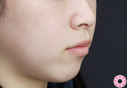 年代：20代 施術名：アゴのヒアルロン酸注入 施術前｜【公式】東京形成美容外科