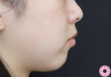 年代：20代 施術名：アゴのヒアルロン酸注入 施術前｜【公式】東京形成美容外科