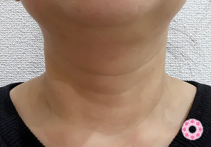 年代：50代 施術名：ネックリフト 施術後｜【公式】東京形成美容外科