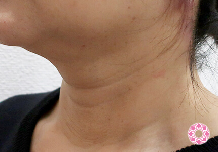 年代：50代 施術名：ネックリフト 施術後｜【公式】東京形成美容外科