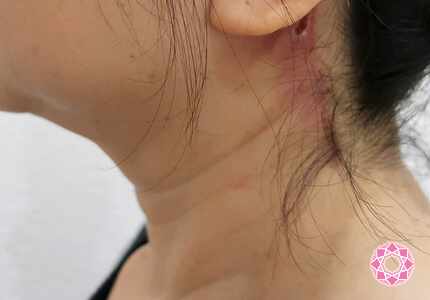 年代：50代 施術名：ネックリフト 施術後｜【公式】東京形成美容外科