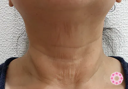 年代：50代 施術名：ネックリフト 施術前｜【公式】東京形成美容外科