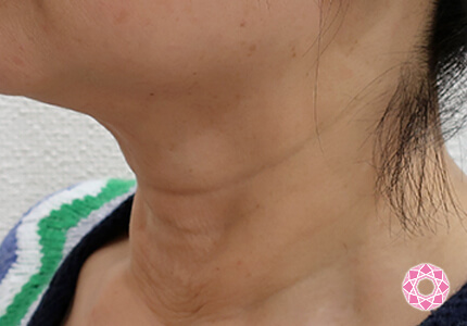 年代：50代 施術名：ネックリフト 施術前｜【公式】東京形成美容外科