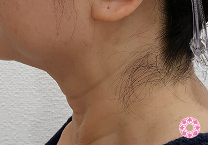 年代：50代 施術名：ネックリフト 施術前｜【公式】東京形成美容外科