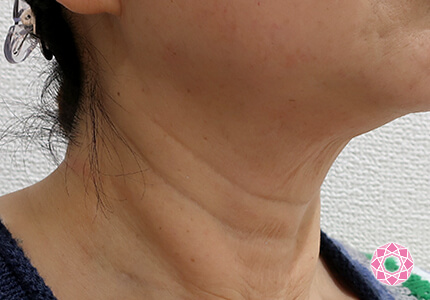 年代：50代 施術名：ネックリフト 施術前｜【公式】東京形成美容外科