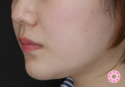 年代：20代 施術名：BNLSアルティメット 施術後｜【公式】東京形成美容外科