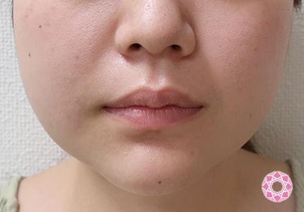 年代：20代 施術名：BNLSアルティメット 施術前｜【公式】東京形成美容外科