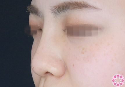 年代：20代 施術名：プチ隆鼻術（ヒアルロン酸） 施術後｜【公式】東京形成美容外科