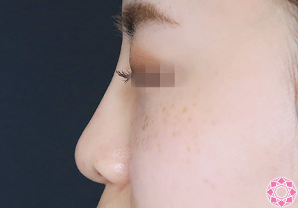 年代：20代 施術名：プチ隆鼻術（ヒアルロン酸） 施術後｜【公式】東京形成美容外科