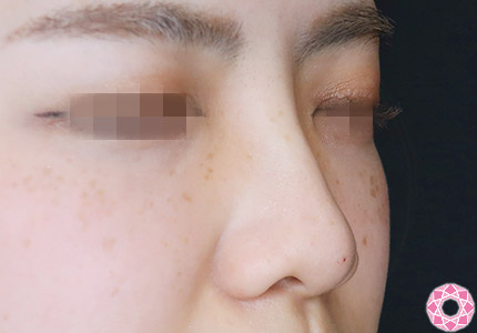 年代：20代 施術名：プチ隆鼻術（ヒアルロン酸） 施術後｜【公式】東京形成美容外科