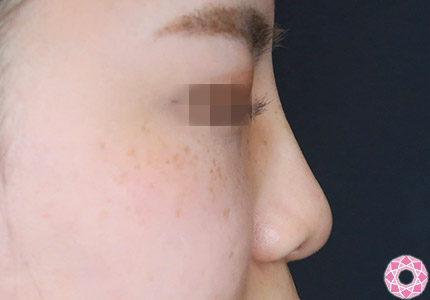 年代：20代 施術名：プチ隆鼻術（ヒアルロン酸） 施術後｜【公式】東京形成美容外科