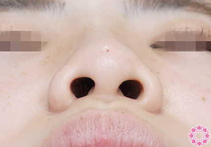 年代：20代 施術名：プチ隆鼻術（ヒアルロン酸） 施術後｜【公式】東京形成美容外科