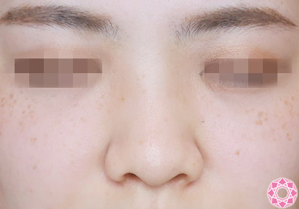 年代：20代 施術名：プチ隆鼻術（ヒアルロン酸） 施術前｜【公式】東京形成美容外科